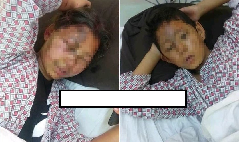 होली खेल्दा रंगमा पानीको साटो एसिड मिसाएर छ्याप्दा काठमाडौँमा ३ जना विद्यार्थी घाइते