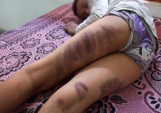 होमवर्कको निहुँमा शिक्षकले कुटे विद्यार्थी