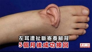 युवतीले ५ महिनासम्म खुट्टामै पालिन् चुँडिएको आफ्नो कान